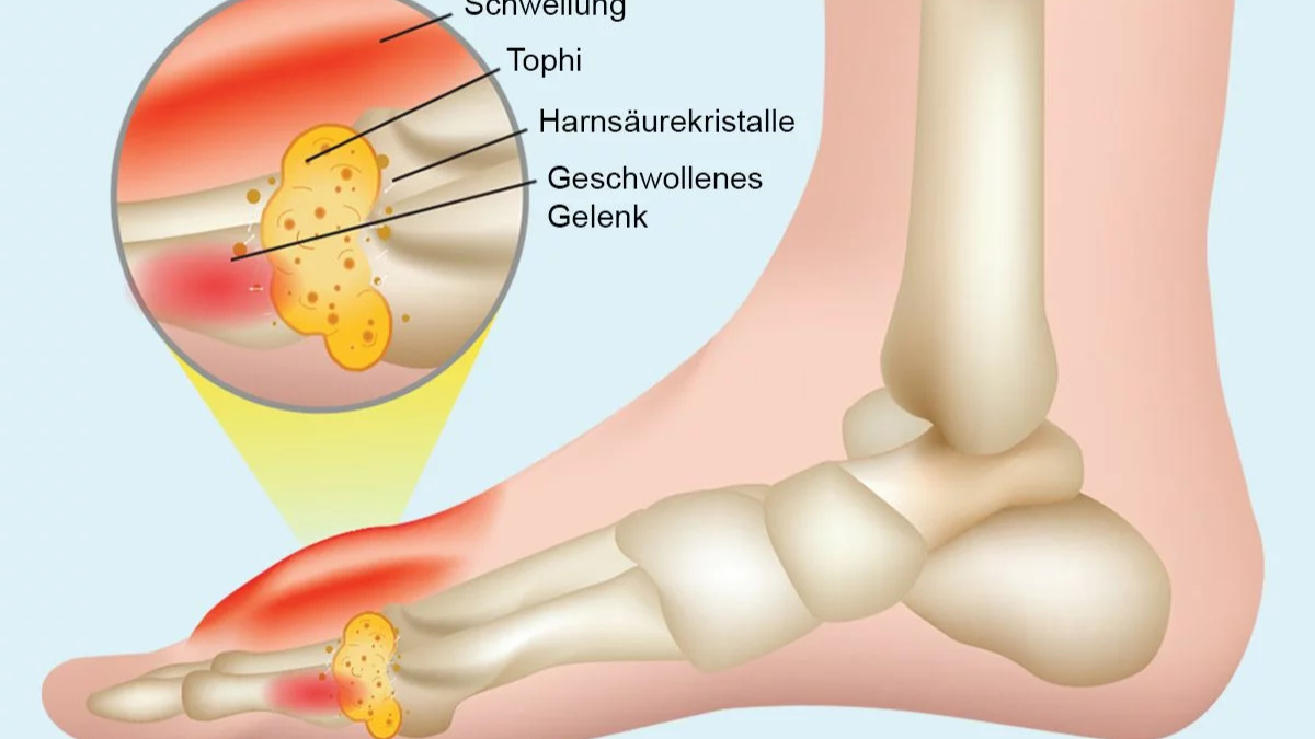 Gicht im Fuß Bilder: So sieht ein akuter Gichtanfall wirklich aus – Symptome, Ursachen und Behandlung im Überblick